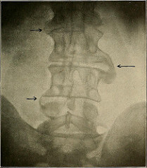 Image from page 168 of osteoarthritis photo - doctor sarno back pain relief with joe polish
